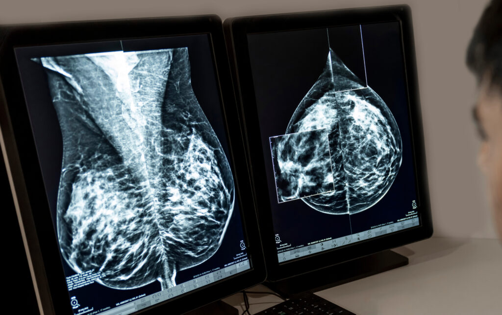 outsourced telemammography